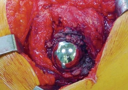 Catastrophic failure due to aggressive metallosis 4 years after hip resurfacing