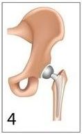 How the implant fits into the hip